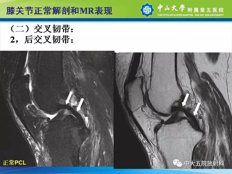 膝关节半月板和韧带损伤的影像学诊断