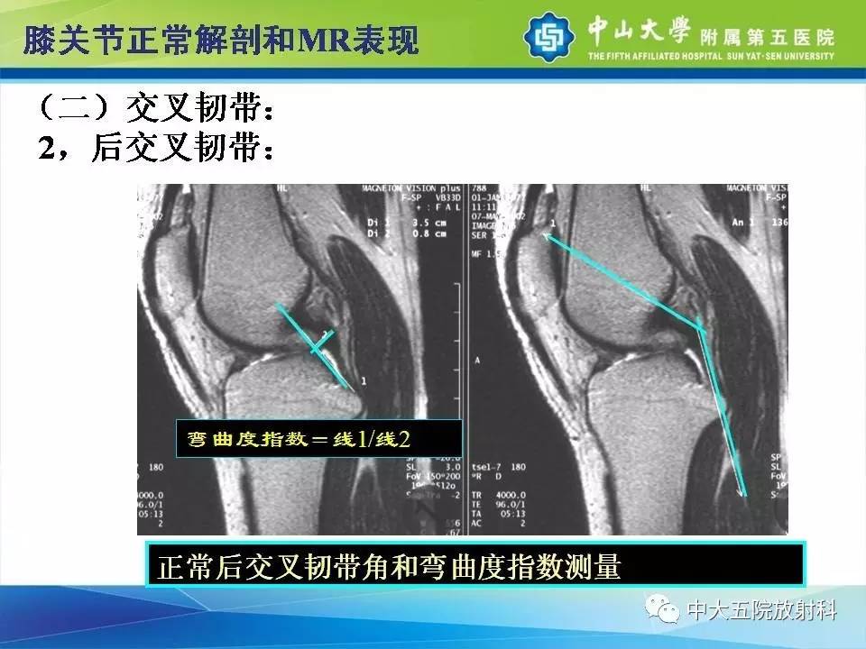 膝关节半月板和韧带损伤的影像学诊断