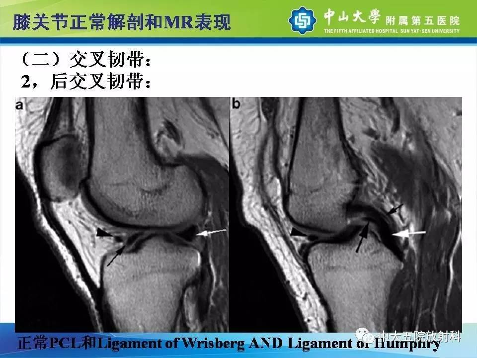 膝关节半月板和韧带损伤的影像学诊断