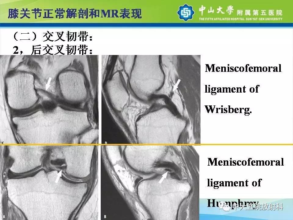 膝关节半月板和韧带损伤的影像学诊断