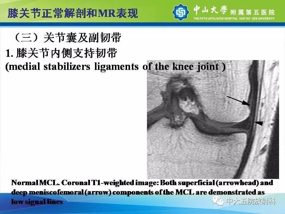 膝关节半月板和韧带损伤的影像学诊断