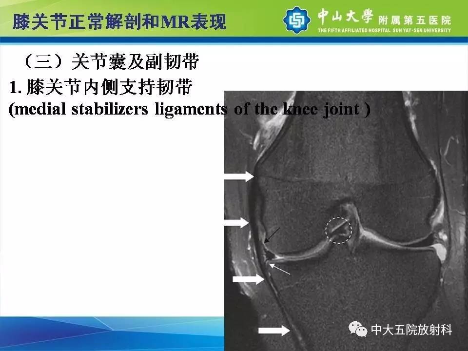 膝关节半月板和韧带损伤的影像学诊断