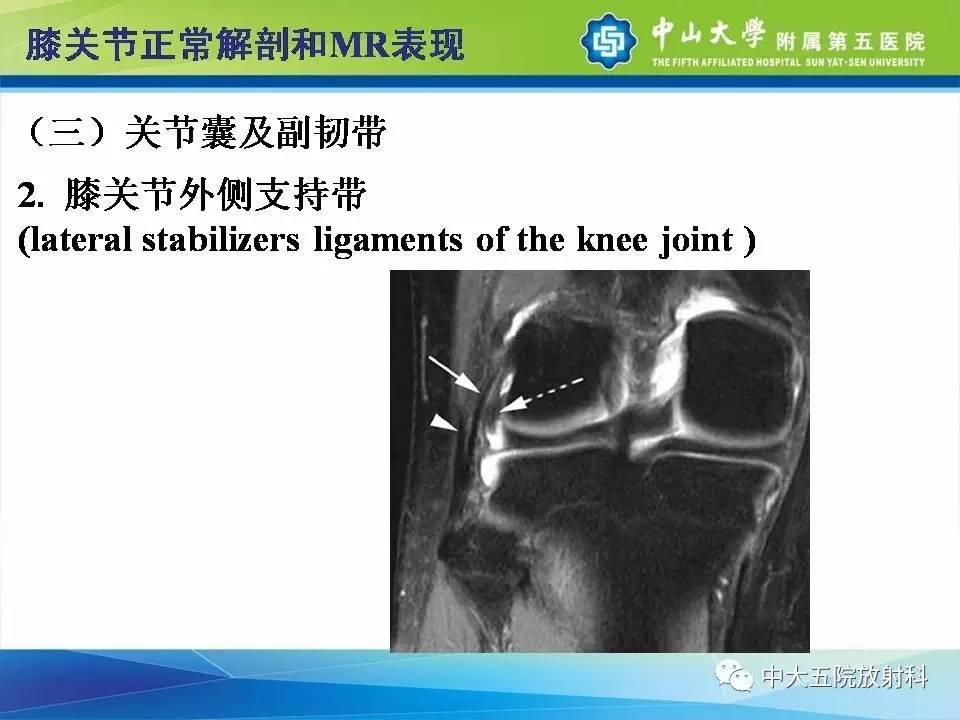 膝关节半月板和韧带损伤的影像学诊断