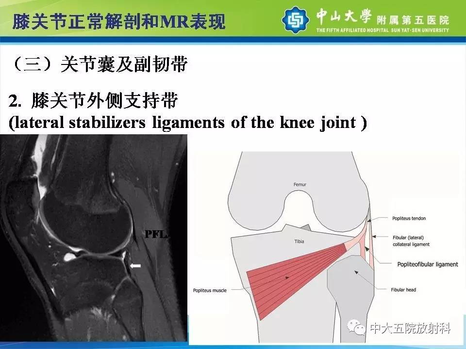 膝关节半月板和韧带损伤的影像学诊断