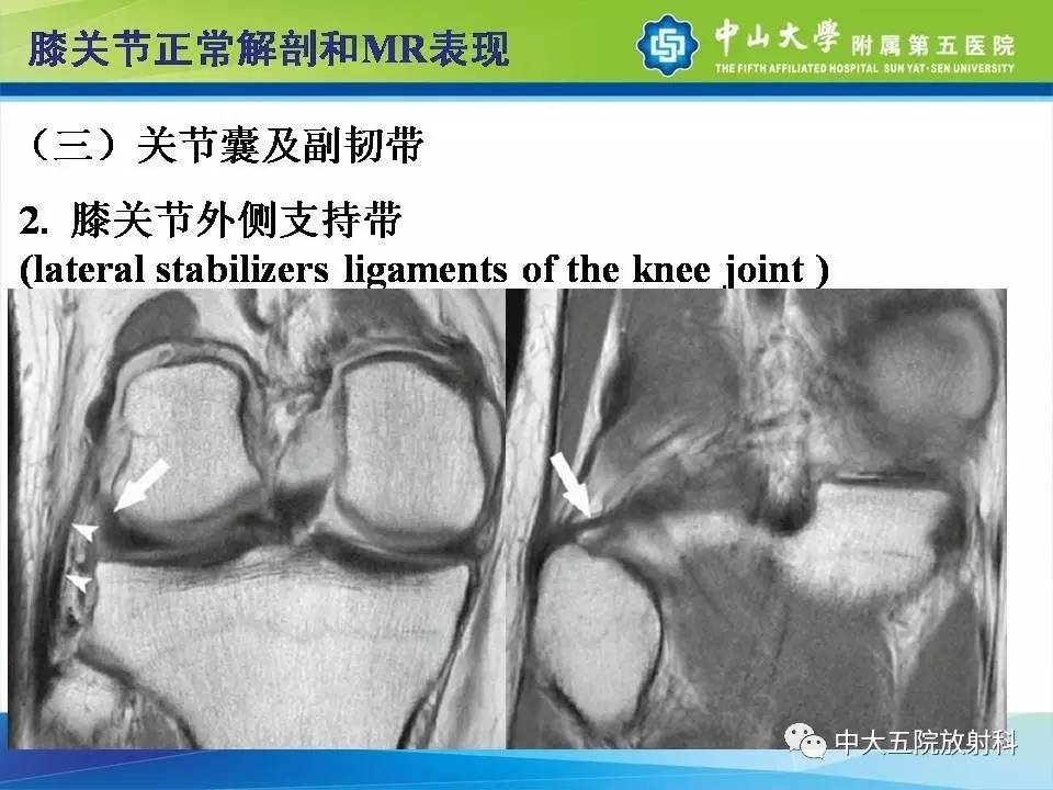 膝关节半月板和韧带损伤的影像学诊断