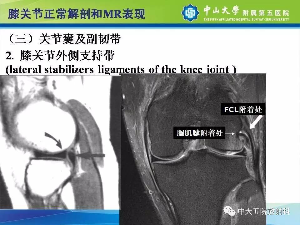 膝关节半月板和韧带损伤的影像学诊断