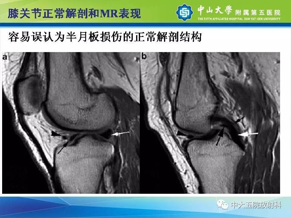 膝关节半月板和韧带损伤的影像学诊断