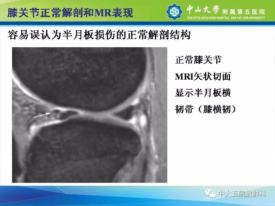 膝关节半月板和韧带损伤的影像学诊断