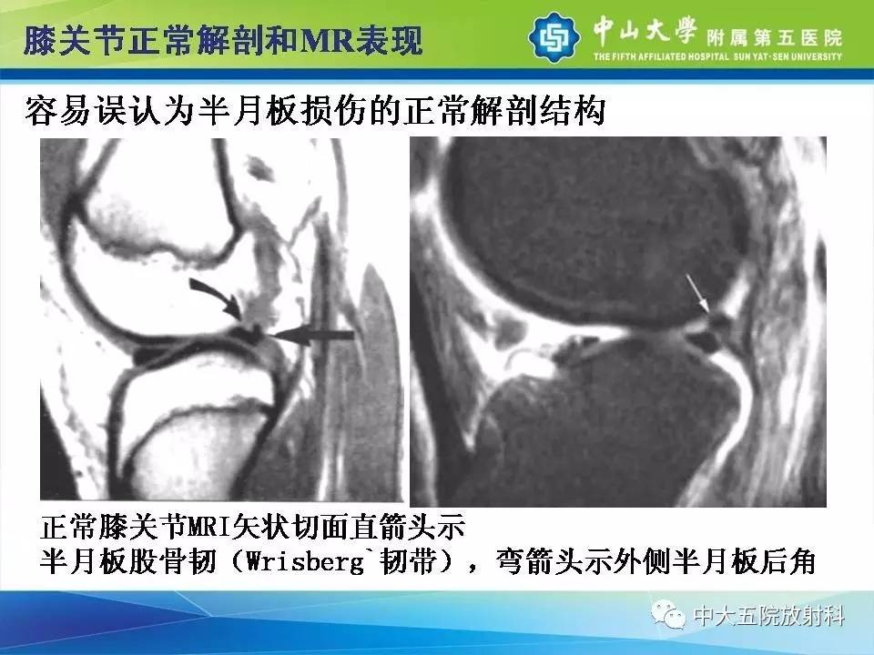 膝关节半月板和韧带损伤的影像学诊断