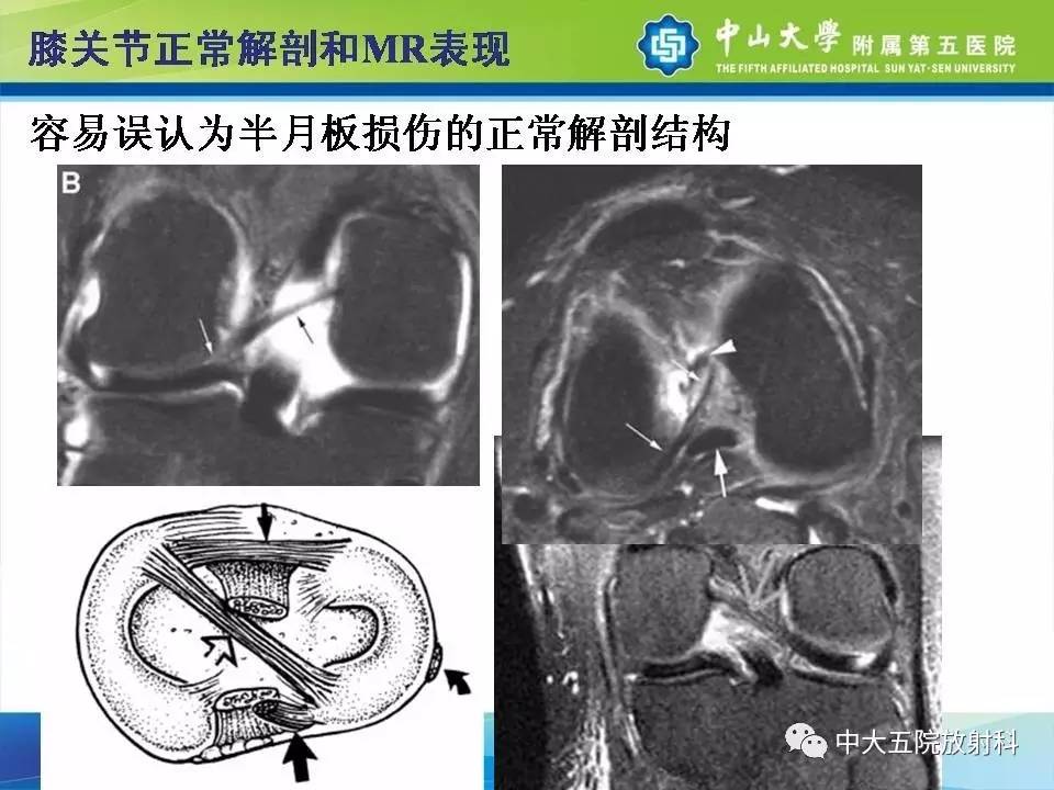 膝关节半月板和韧带损伤的影像学诊断