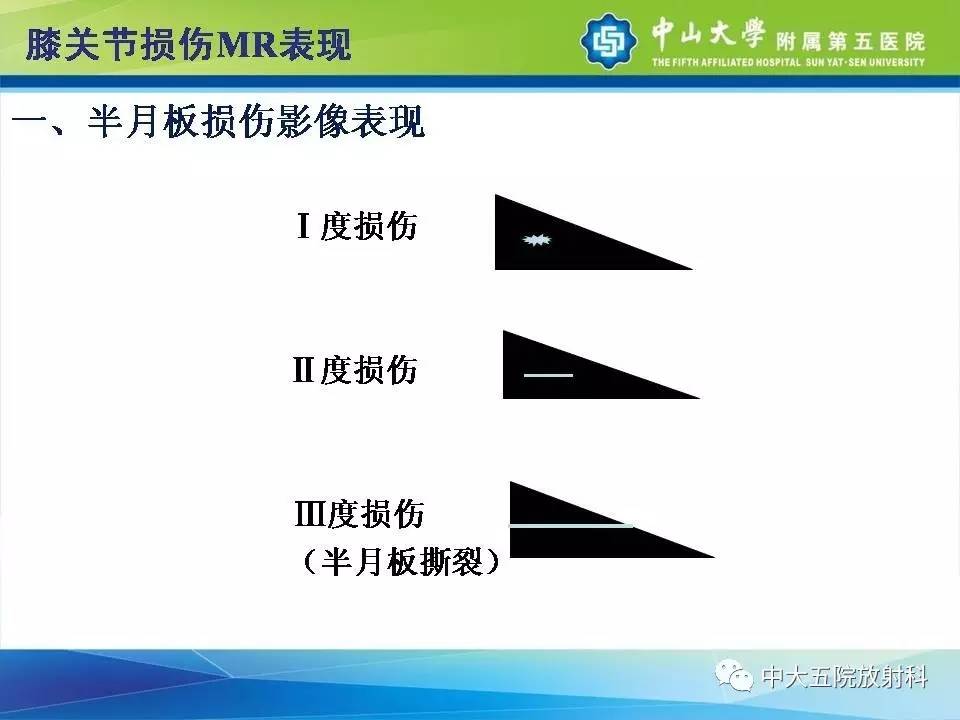 膝关节半月板和韧带损伤的影像学诊断