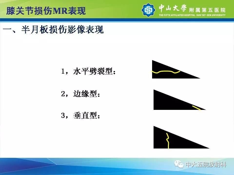 膝关节半月板和韧带损伤的影像学诊断