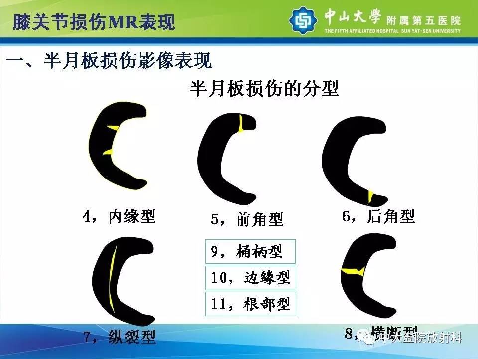 膝关节半月板和韧带损伤的影像学诊断