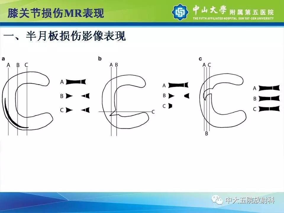 膝关节半月板和韧带损伤的影像学诊断