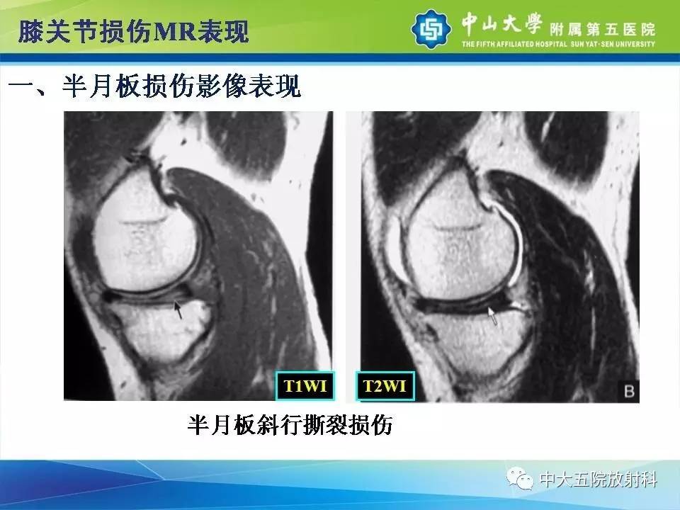 膝关节半月板和韧带损伤的影像学诊断