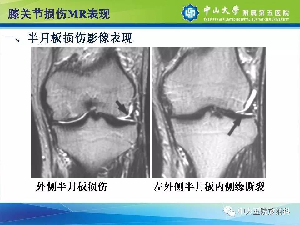 膝关节半月板和韧带损伤的影像学诊断