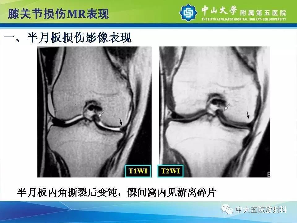 膝关节半月板和韧带损伤的影像学诊断