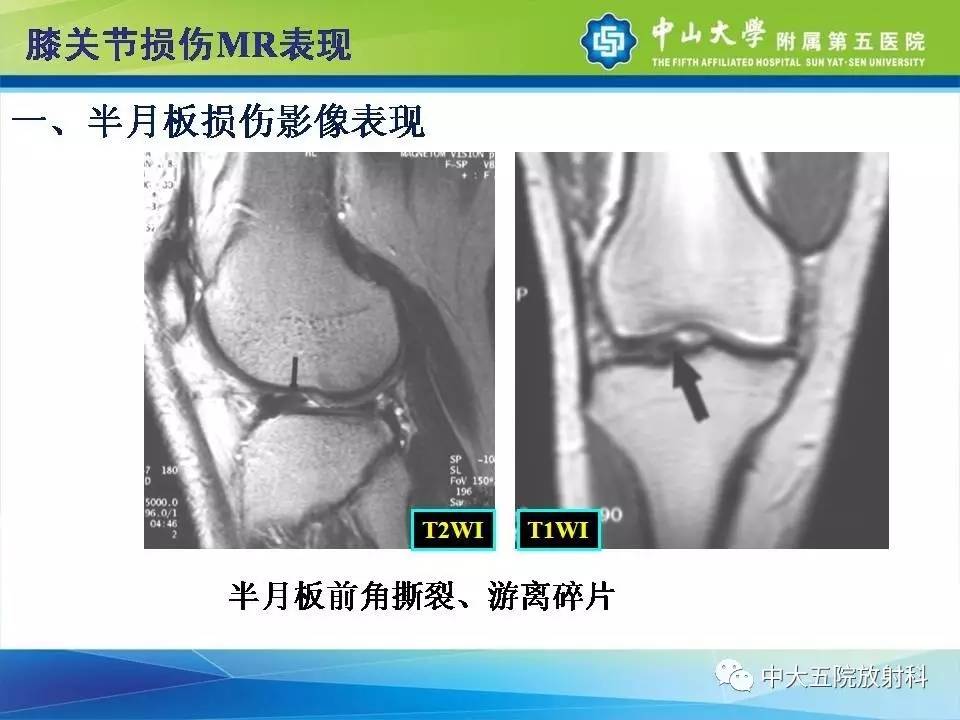 膝关节半月板和韧带损伤的影像学诊断