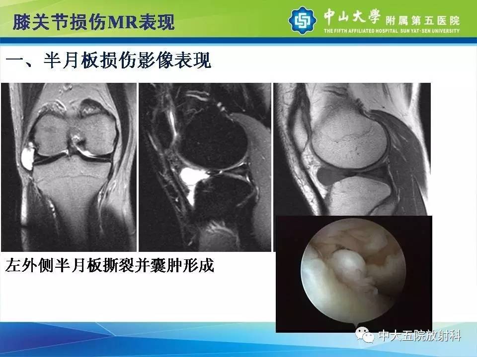 膝关节半月板和韧带损伤的影像学诊断