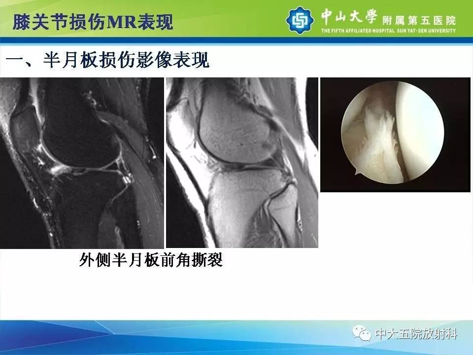 膝关节半月板和韧带损伤的影像学诊断