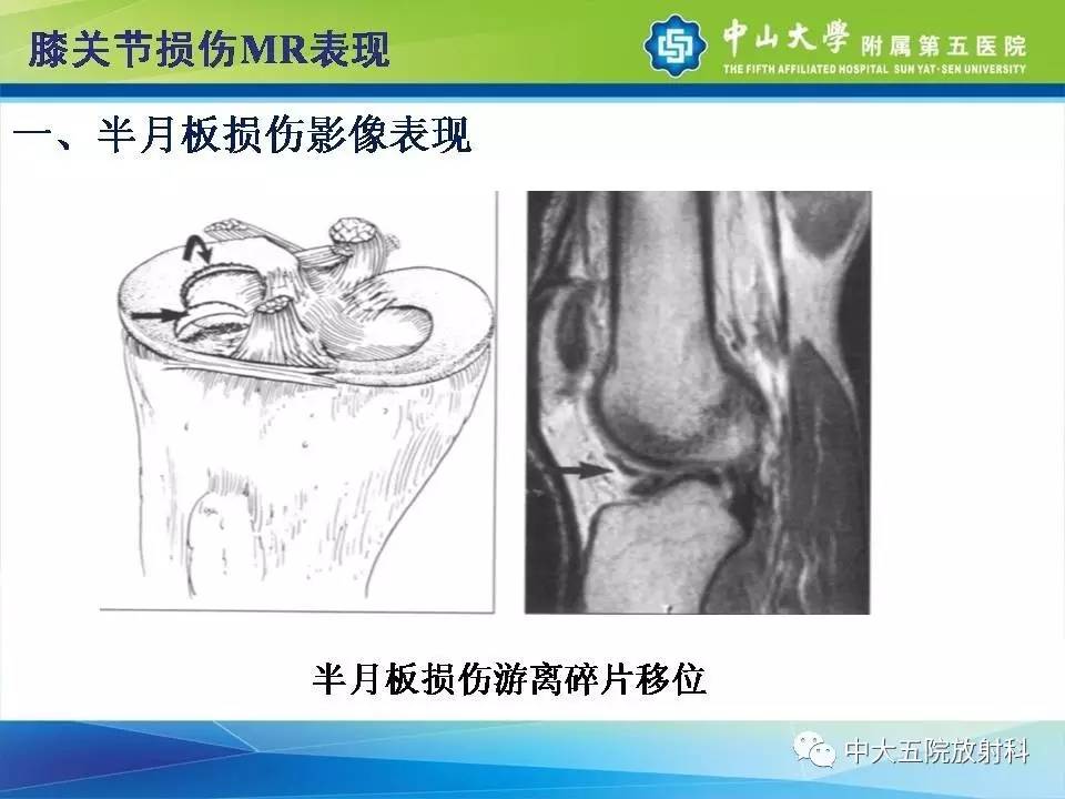 膝关节半月板和韧带损伤的影像学诊断