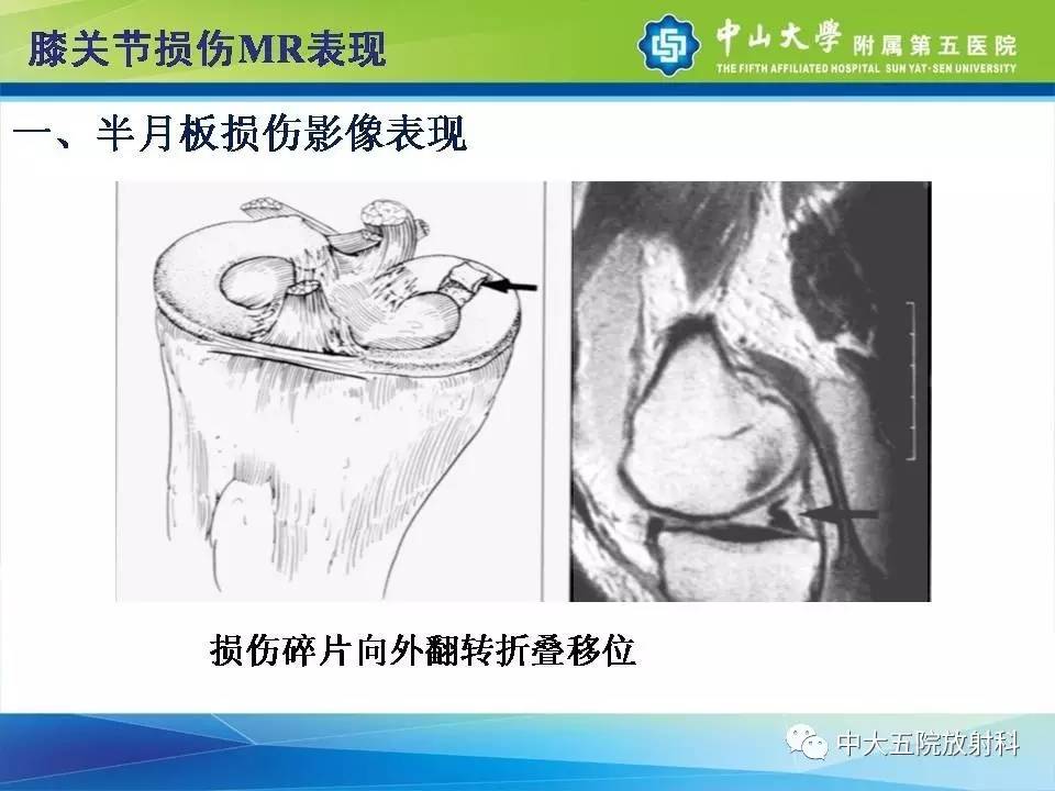 膝关节半月板和韧带损伤的影像学诊断