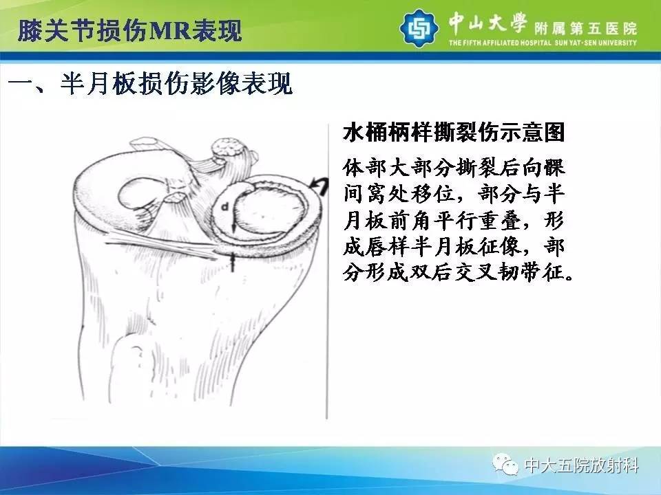 膝关节半月板和韧带损伤的影像学诊断