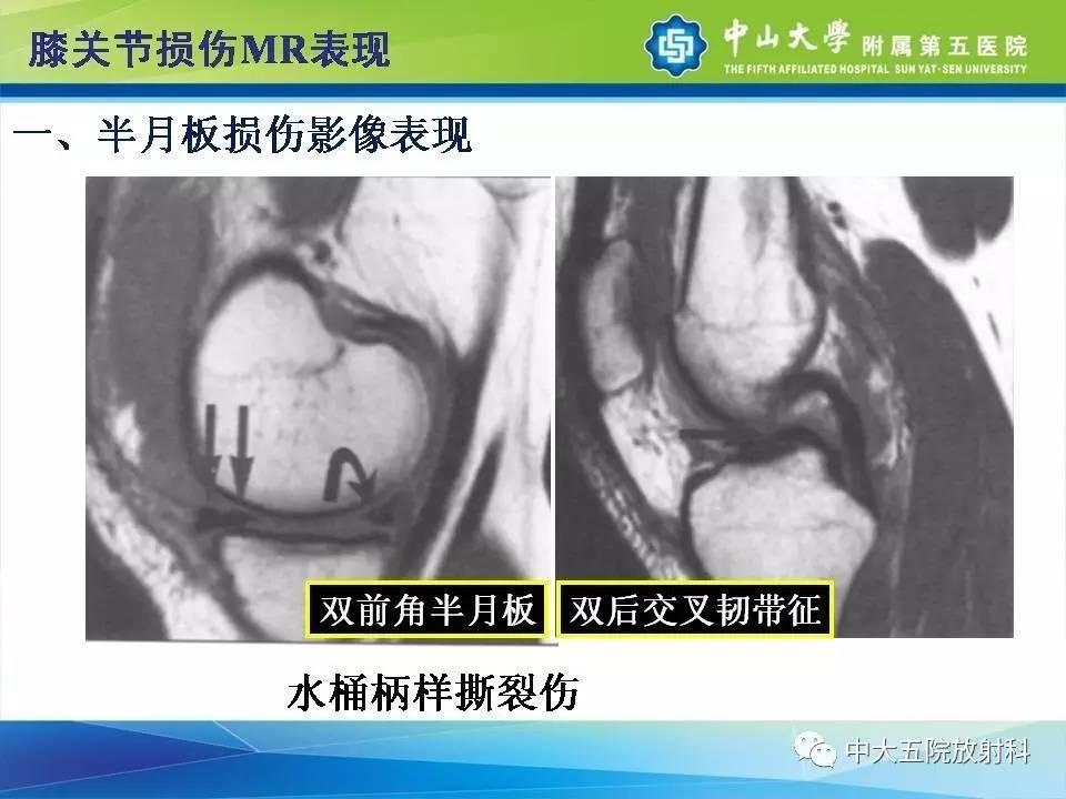 膝关节半月板和韧带损伤的影像学诊断