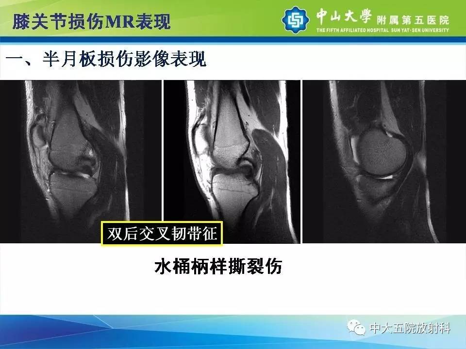 膝关节半月板和韧带损伤的影像学诊断