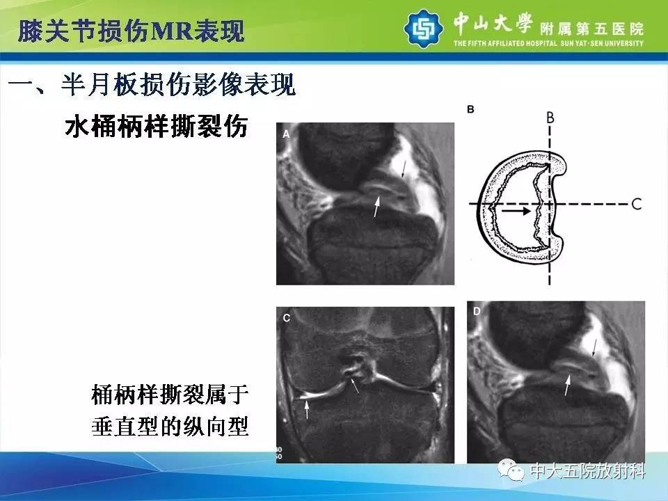 膝关节半月板和韧带损伤的影像学诊断