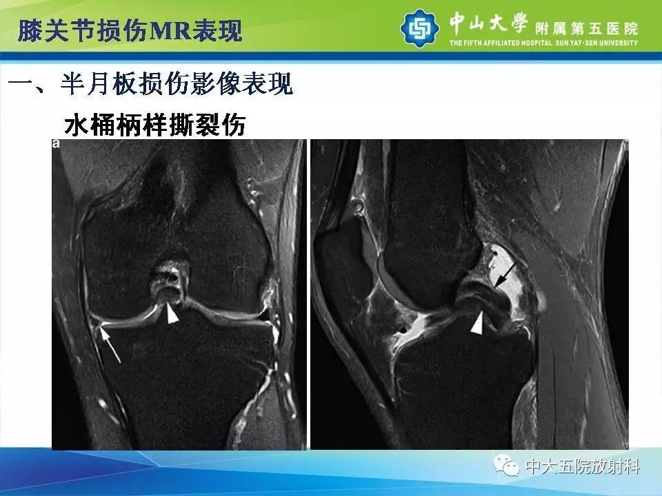 膝关节半月板和韧带损伤的影像学诊断