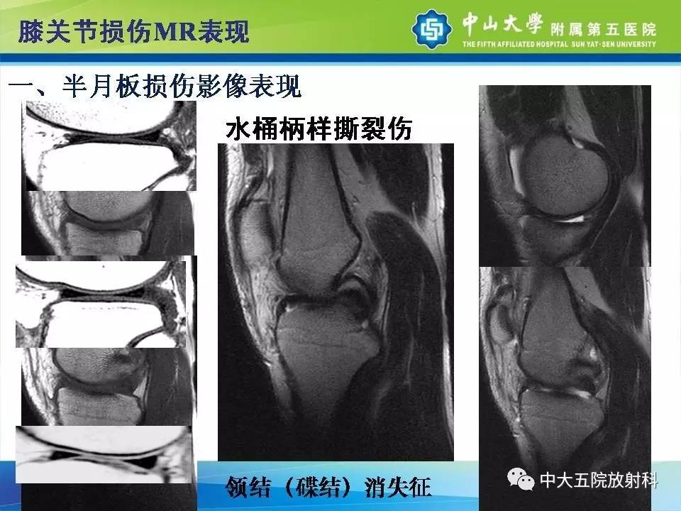 膝关节半月板和韧带损伤的影像学诊断