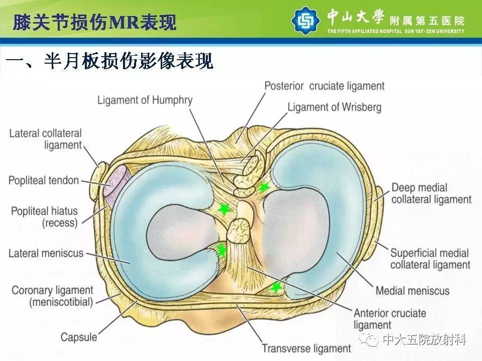 膝关节半月板和韧带损伤的影像学诊断