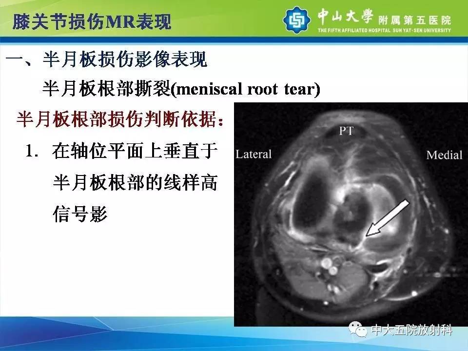 膝关节半月板和韧带损伤的影像学诊断