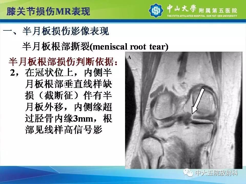 膝关节半月板和韧带损伤的影像学诊断