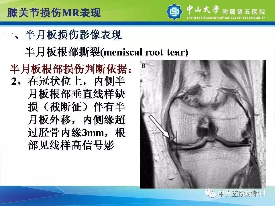 膝关节半月板和韧带损伤的影像学诊断