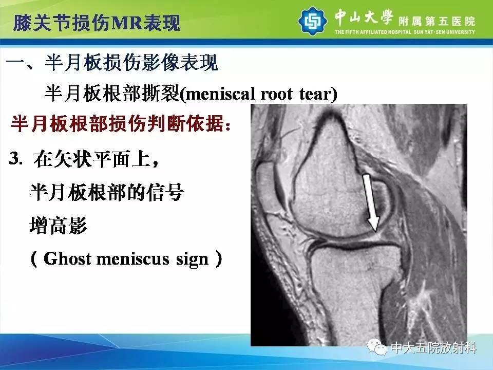 膝关节半月板和韧带损伤的影像学诊断