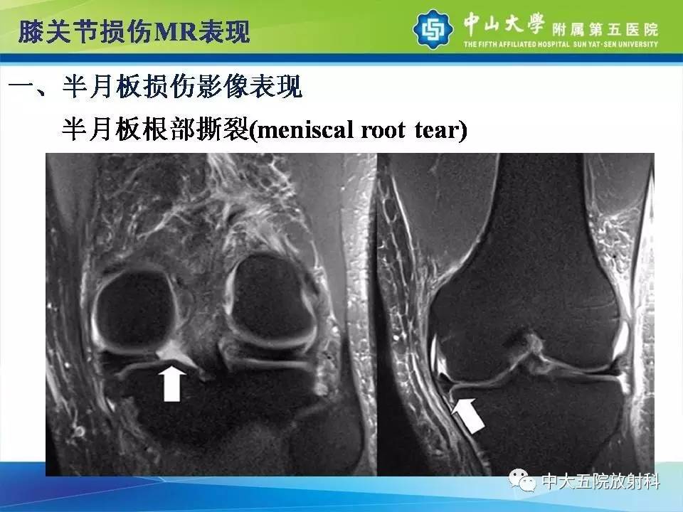 膝关节半月板和韧带损伤的影像学诊断