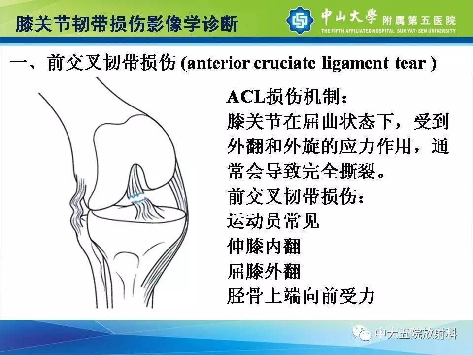 膝关节半月板和韧带损伤的影像学诊断