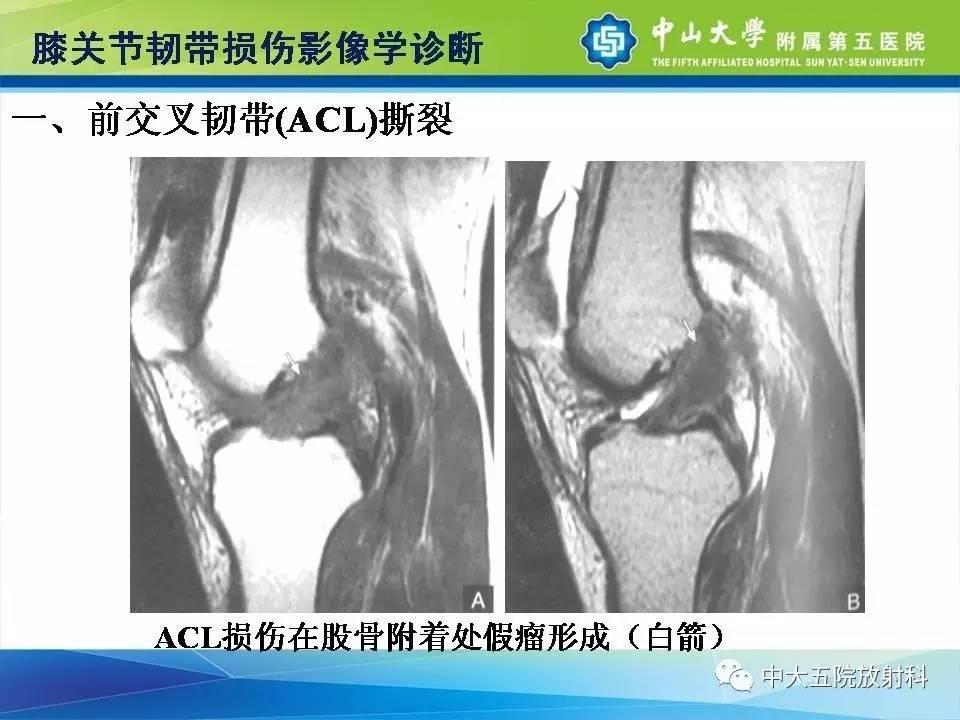 膝关节半月板和韧带损伤的影像学诊断