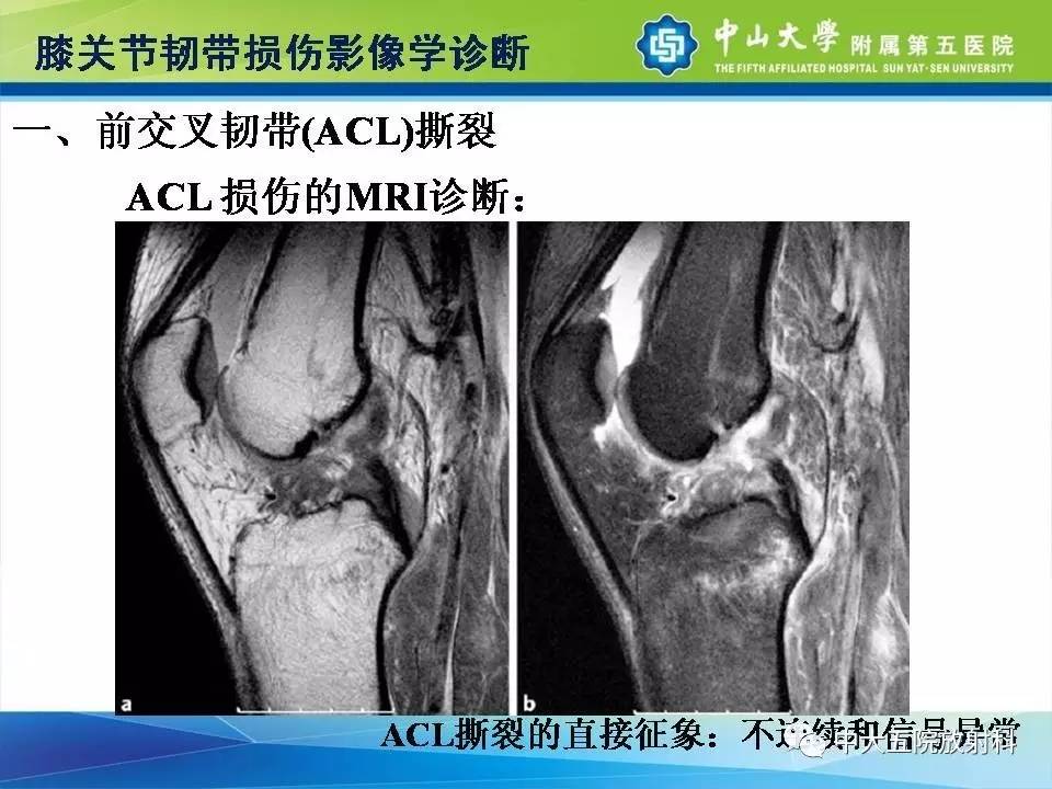 膝关节半月板和韧带损伤的影像学诊断