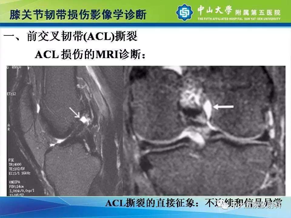 膝关节半月板和韧带损伤的影像学诊断