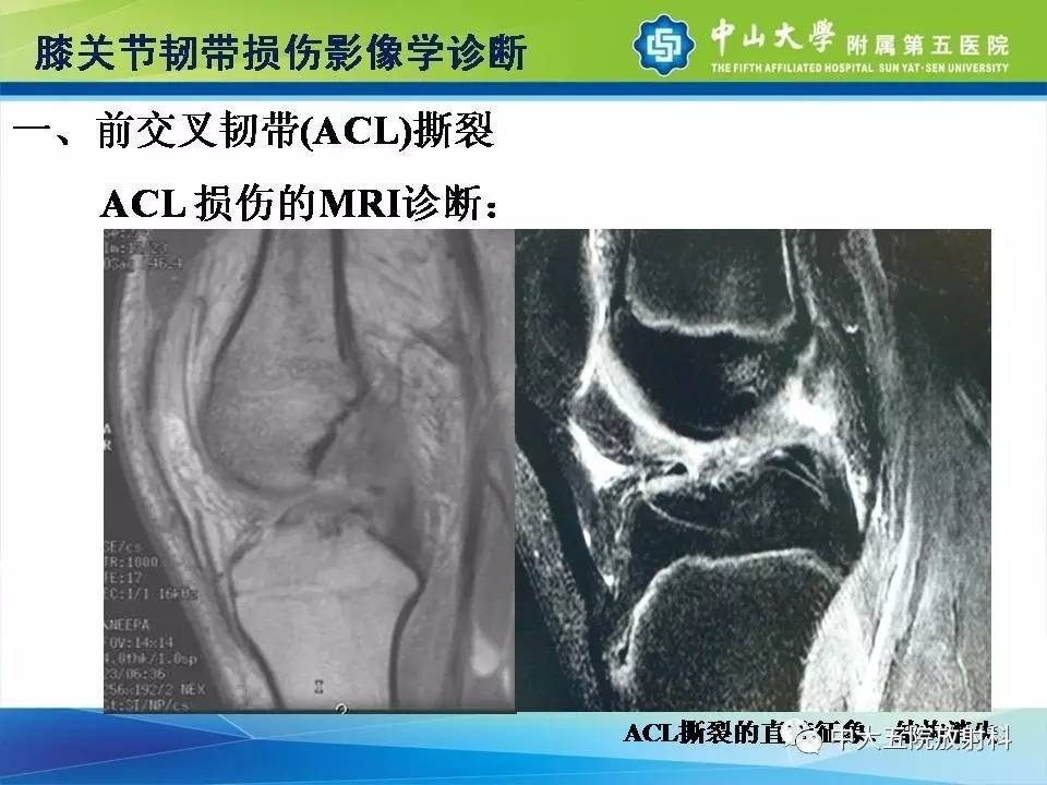 膝关节半月板和韧带损伤的影像学诊断