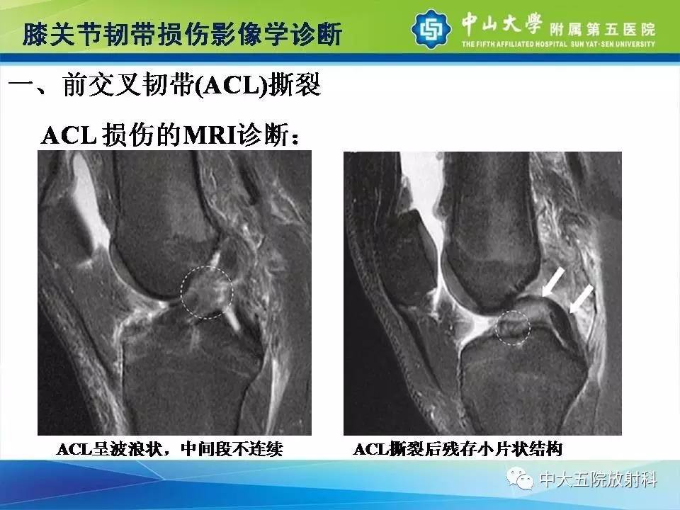 膝关节半月板和韧带损伤的影像学诊断