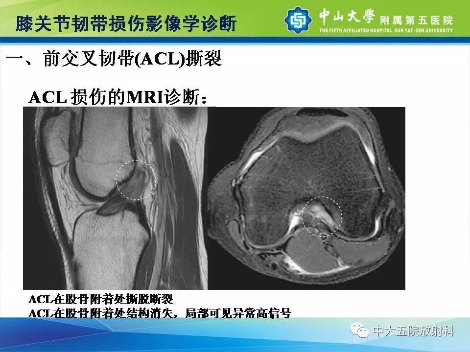 膝关节半月板和韧带损伤的影像学诊断