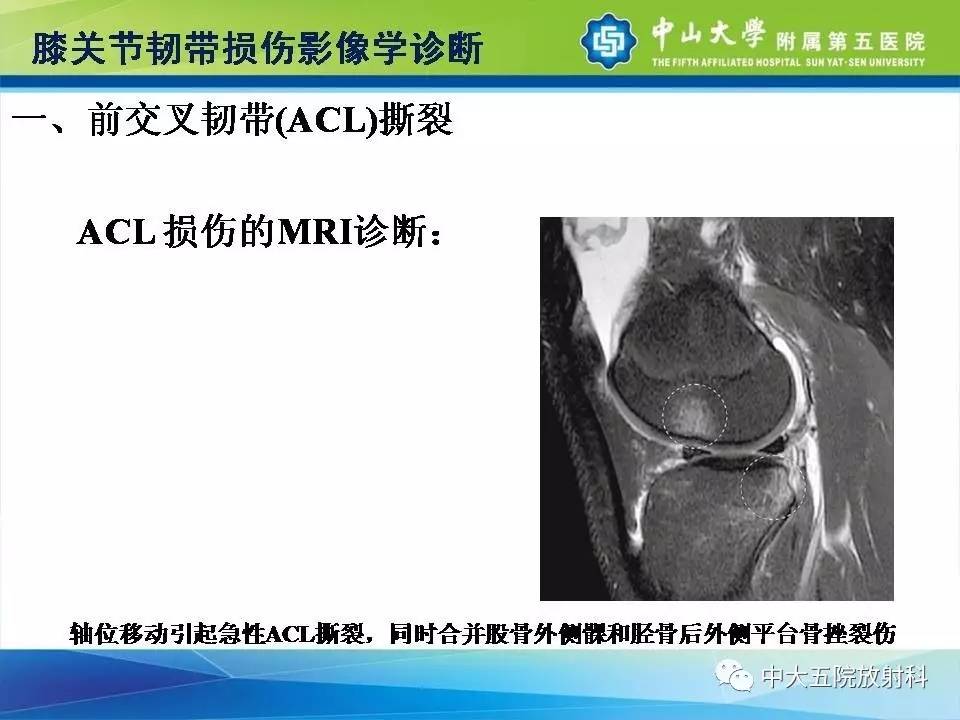 膝关节半月板和韧带损伤的影像学诊断