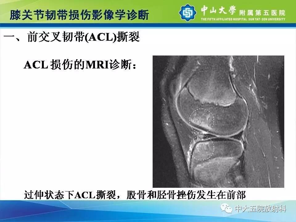 膝关节半月板和韧带损伤的影像学诊断