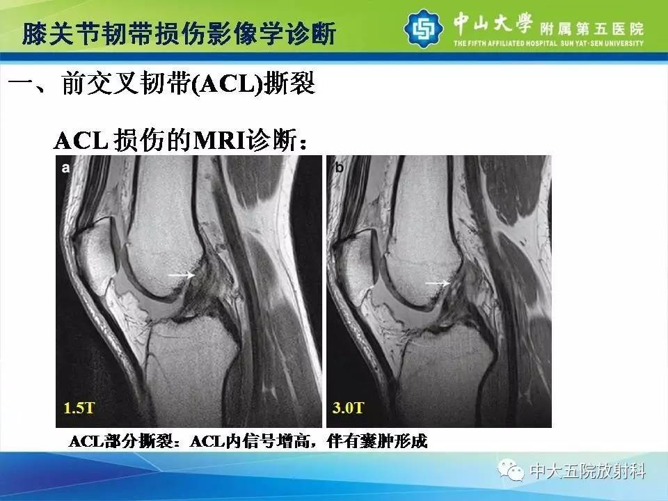 膝关节半月板和韧带损伤的影像学诊断