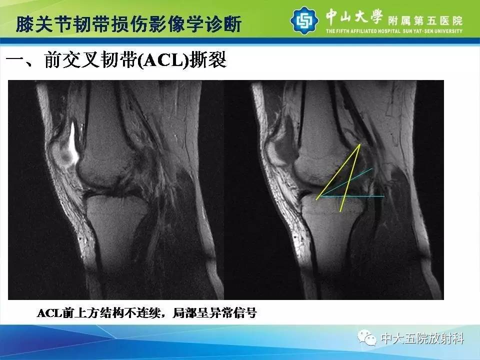 膝关节半月板和韧带损伤的影像学诊断