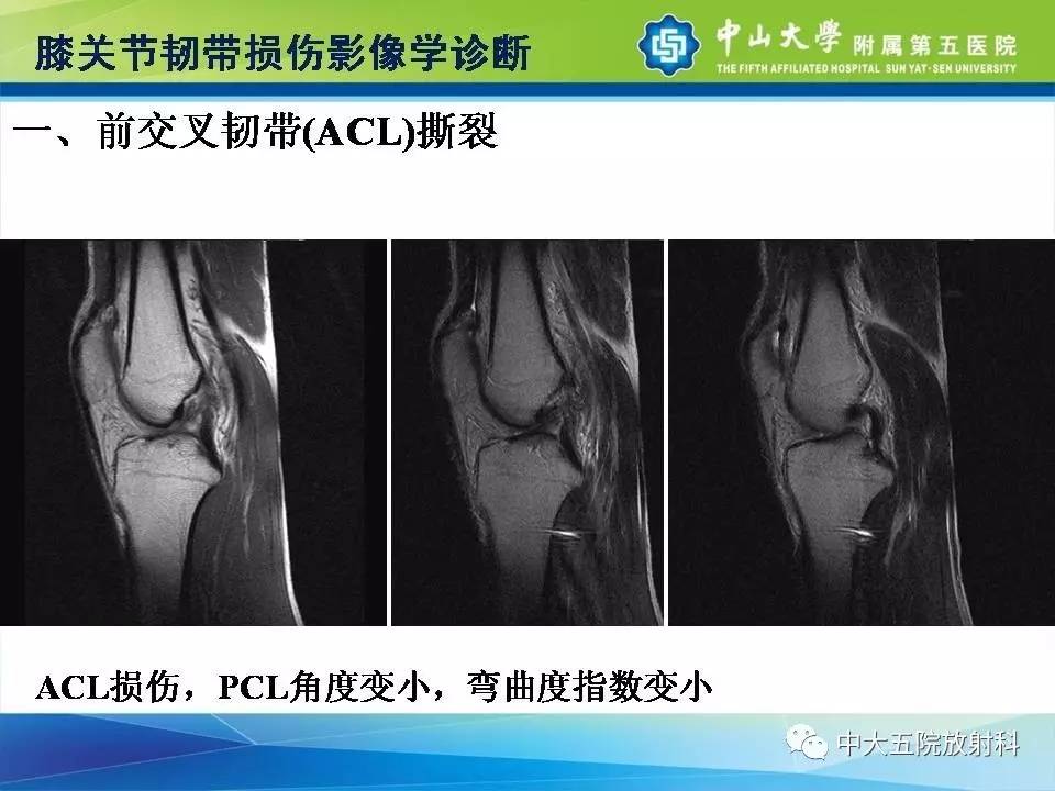 膝关节半月板和韧带损伤的影像学诊断